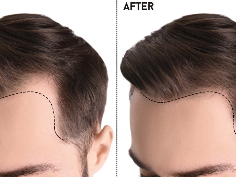 TRAPIANTO DI CAPELLI